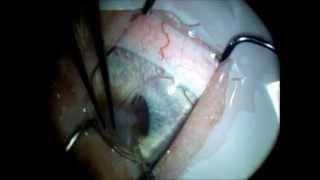 Lamelar Keratoplasty followed by a xenotransplant Frozen cornea [upl. by Sontich485]