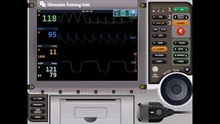 Capnography Waveform with ROSC [upl. by Anerat852]