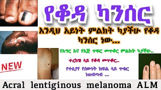 Acral lentiginous melanoma ALM  የቆዳ ካንሰር  የጤና ቃል [upl. by Neffirg]