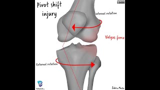 Contrecoup injury ACL tear [upl. by Ateval924]