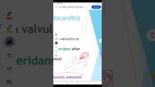 Infective endocarditis [upl. by Anayia]