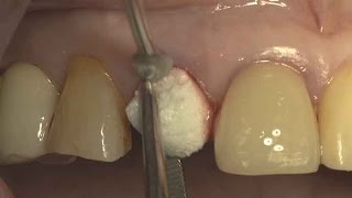 Immediate implantation with flapless simple grafting on upper anterior area [upl. by Elma]