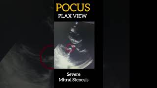 POCUS  Severe Mitral Stenosis  2D ECHO  PLAX View [upl. by Oconnor212]