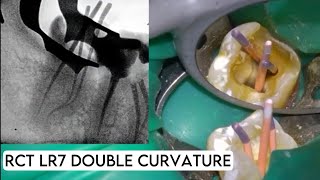 Live Root Canal treatment Double curvature [upl. by Geer337]