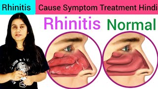 Rhinitis Type Cause Symptom Diagnosis Treatment in Hindi  What is Rhinitis  Treatment of Rhinitis [upl. by Gustafson537]