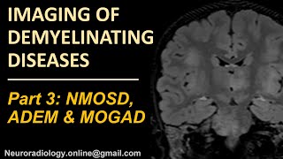 Imaging of demyelinating disorders part 3  NMOSD MOGAD and ADEM [upl. by Anhavas]