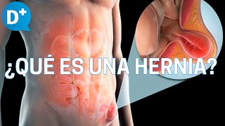 Hernias ¿Qué es una hernia y por qué se produce [upl. by Oulman]