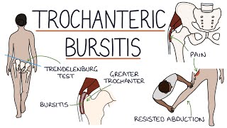 Understanding Trochanteric Bursitis [upl. by Marianna]