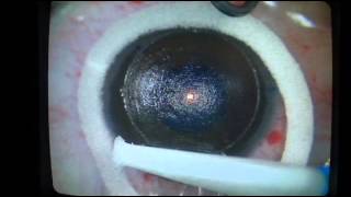 Femto Lasik with Alcon LensX and Wavelight EX500 Excimer Laser  ProfDr Pandelis Papadopoulos [upl. by Mendive]