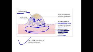 keratoacanthoma [upl. by Warfield]