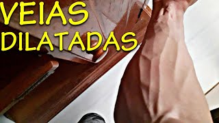 🔴Como ter VEIAS SALTADAS Sem usar hormônios dilatadas dilatação [upl. by Janelle79]