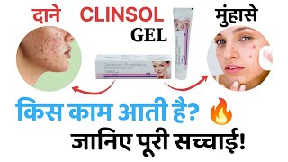 दाने और मुंहासे के लिए। Clinsol Gel review in hindi  clinsol benefitsside effects  clinsol gel [upl. by Yeltnerb]