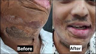 Face Scar Treatment Results [upl. by Benedix]