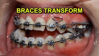 Braces transformation  35 month duration [upl. by Balthasar682]