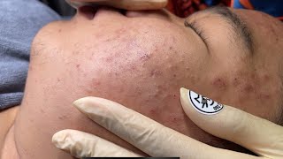 Blackheads amp Whiteheads Removal New 2024  Acne Treatment With Bo Nguyễn Spa 008 [upl. by Gnav]