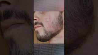 1 ANO E 6 MESES usando Minoxidil minoxidil foligain evolução minoxidil barba barbearia [upl. by Kilar859]