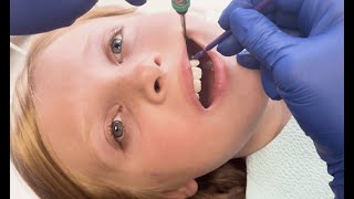 AwardWinning FluoroDose Fluoride Varnish Application [upl. by Akzseinga602]