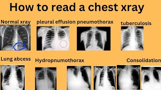 Normal chest xray pleuraleffusiontbxraychestxray [upl. by Latrena492]