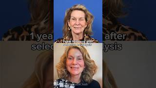 1 year follow up after selective neurolysis facialparalysis synkinesis acousticneuroma [upl. by Estrin]