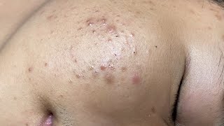 ACNE TREATMENT VU QUYNH MI  Perennial Blackheads On Boy Face 2024FULL [upl. by Alraep]