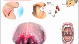 Streptococcus Pyogenes [upl. by Chelsey]