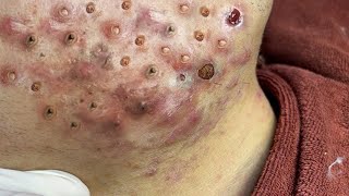 Big Cystic Acne Blackheads Extraction Blackheads amp Milia Whiteheads Removal Pimple Popping  3791 [upl. by Meunier462]