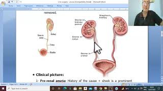 Urosurgery in Arabic 17 Anuria  part 1   by Dr Wahdan [upl. by Dublin]