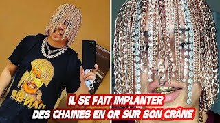 IL SE FAIT IMPLANTER DES CHAINES EN OR SUR SON CRÂNE [upl. by Jillian]