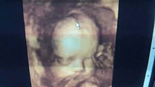 Fontanelle by 4D ultrasound [upl. by Morlee]