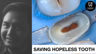 SAVING HOPELESS TOOTH  DENTIST  DR RIZAL RIZKY AKBAR [upl. by Siramaj]