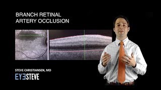 Branch Retinal Artery Occlusion [upl. by Cathlene]