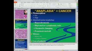 Medical School Pathology 2012 Session 011 Neoplasms Imp4 [upl. by Armelda]