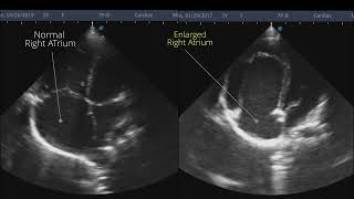 Ebsteins anomaly  Point of Care ECHO  Short Video [upl. by Hoehne865]