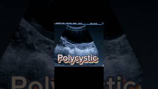 Follicular Ovary  Polycystic Ovaries  PCOS  PCOD  Dominant Follicle on Ultrasound [upl. by Sturdivant]