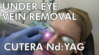 Under Eye Vein Removal Cutera NdYAG Laser  Dr Paul Ruff  West End Plastic Surgery [upl. by Aihsatal]