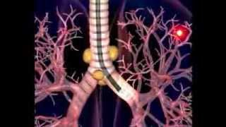 Video Assisted Thoracoscopic Surgery [upl. by Shear]