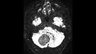 Hemangioblastoma [upl. by Imailiv894]