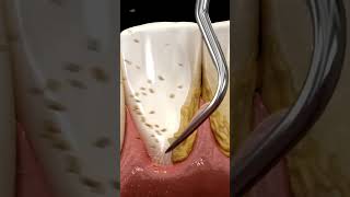 Plaque removal from teeth Waterpick method of plaque removal Teeth teethcleaning [upl. by Dodie]