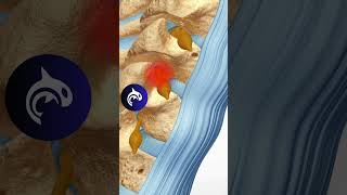 Cervical Selective Nerve Root Block SNRB anatomy orthopedics spine [upl. by Zavras]