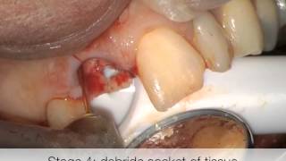 Atraumatic extraction and socket preservation using ErCrYSGG laser [upl. by Casie]