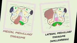 Medial amp Lateral Medullary Syndromes  Wallenberg Syndrome  Vascular lesions of Medulla [upl. by Atterg142]