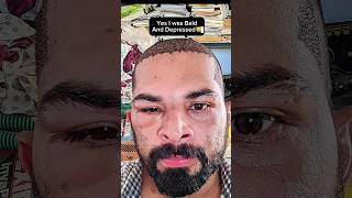 My Hair Transplant Results💥💥💥ameerht hairtransplant hairlosstreatment [upl. by Inafets]