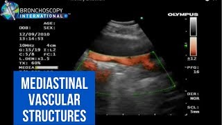 BronchAtlas EBUS and Suspected Pulmonary Embolism [upl. by Miguel]