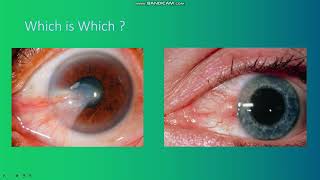 Pterygium vs Pinguecula in 4 mins [upl. by Kciredorb]