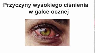 Wysokie ciśnienie w oku  przyczyny objawy i leczenie [upl. by Piefer]