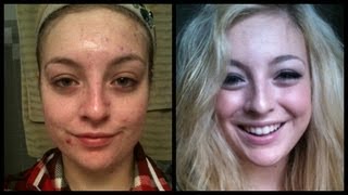 End of Accutane Before and After [upl. by Aynav298]