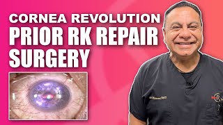 Corneal RK Radial Keratotomy Repair with Topographic Guided Ablation [upl. by Nawyt790]