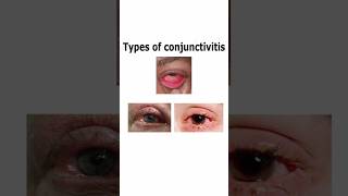 Types Of Conjunctivitis nationalpandeyg redeye eyediseases eyecare [upl. by Voorhis]