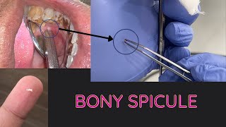 Bone Spicule  Minor Surgery [upl. by Lrae778]