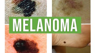 Melanoma vs Benign Melanocytic Nevus  Lecturio Dermatology [upl. by Omocaig]